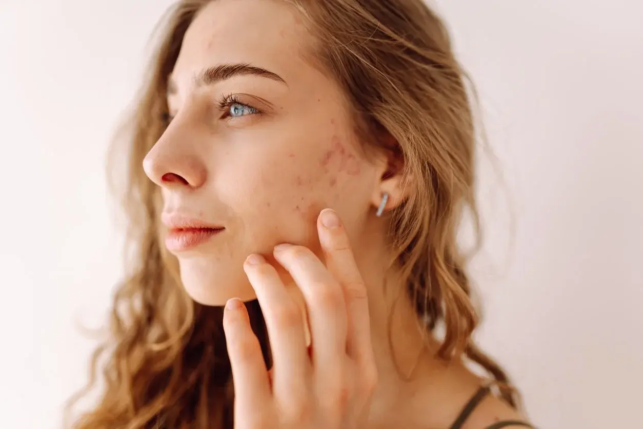 Acne evaluation