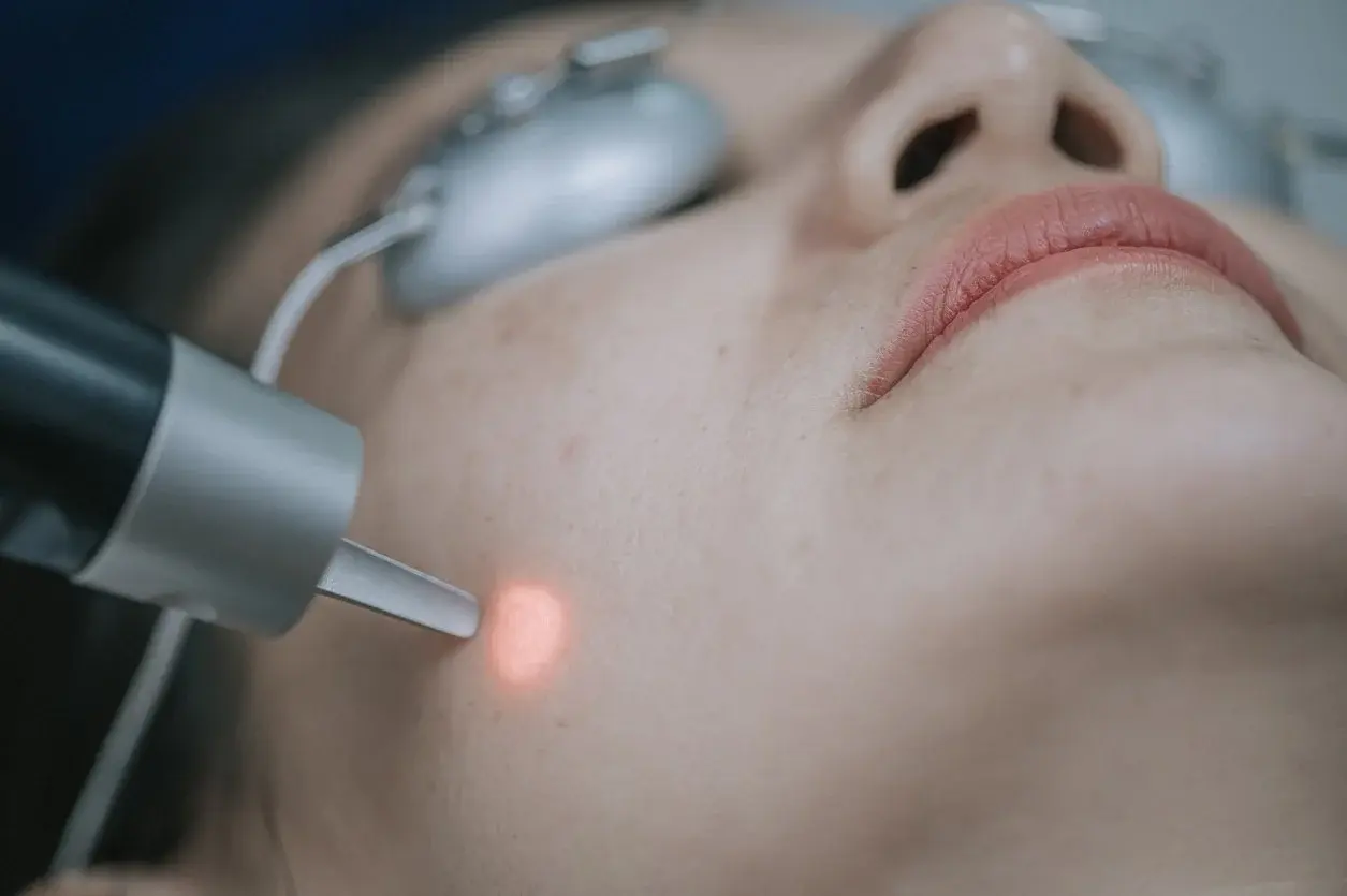 Laser skin treatment