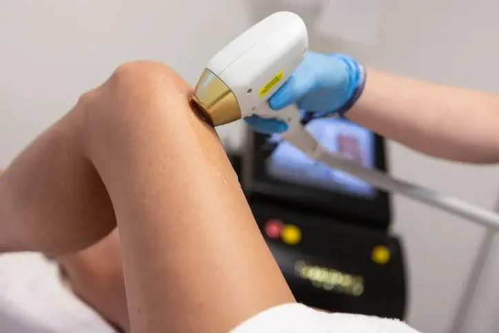 Laser hair removal treatment