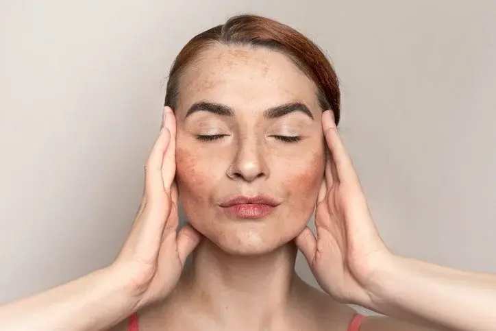 Woman with melasma