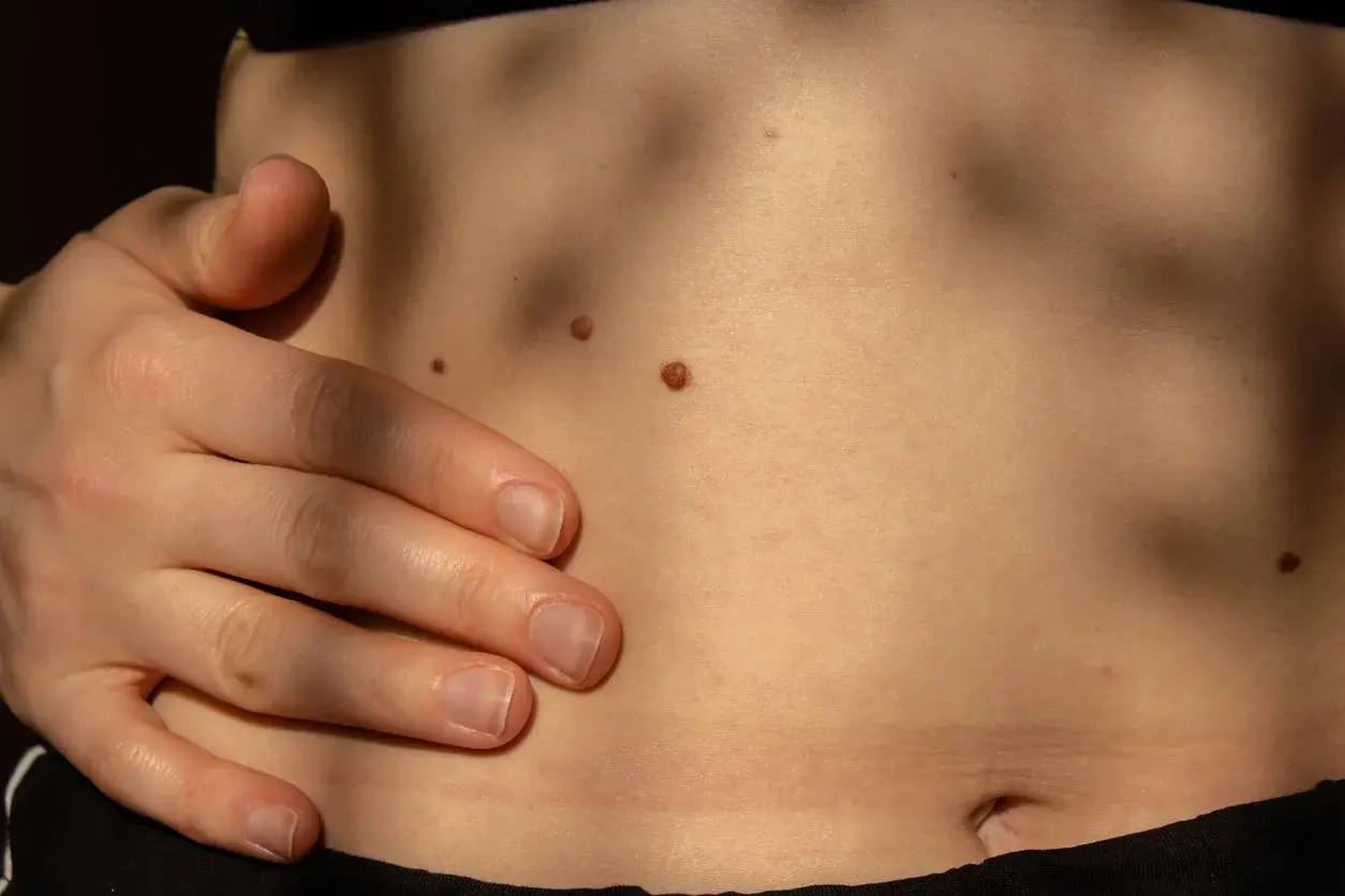 Mole examination