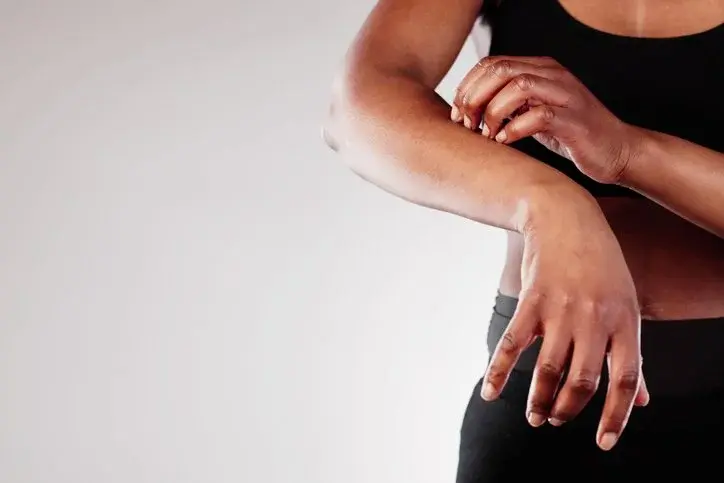 Woman with psoriasis