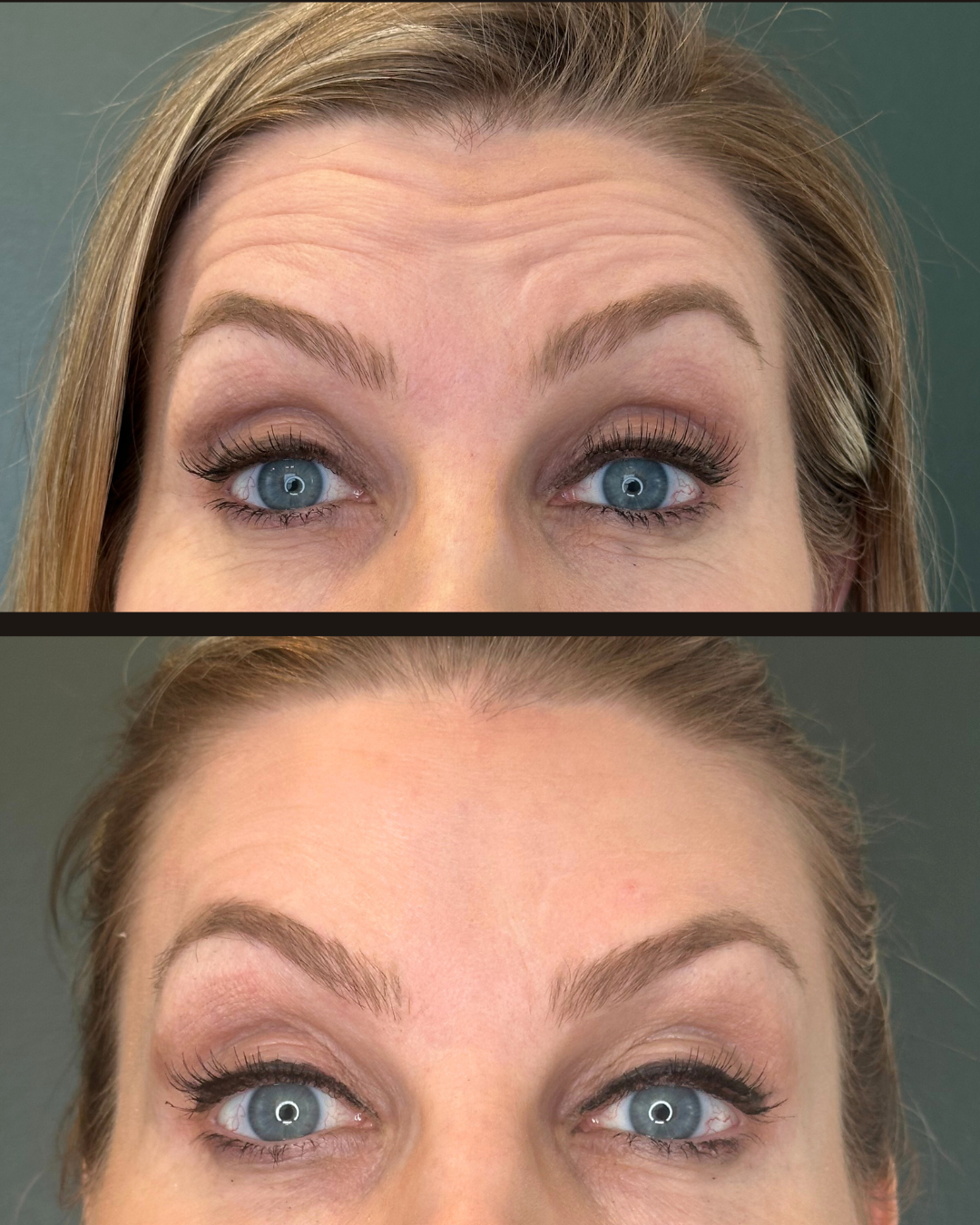Botox before and after - Forehead