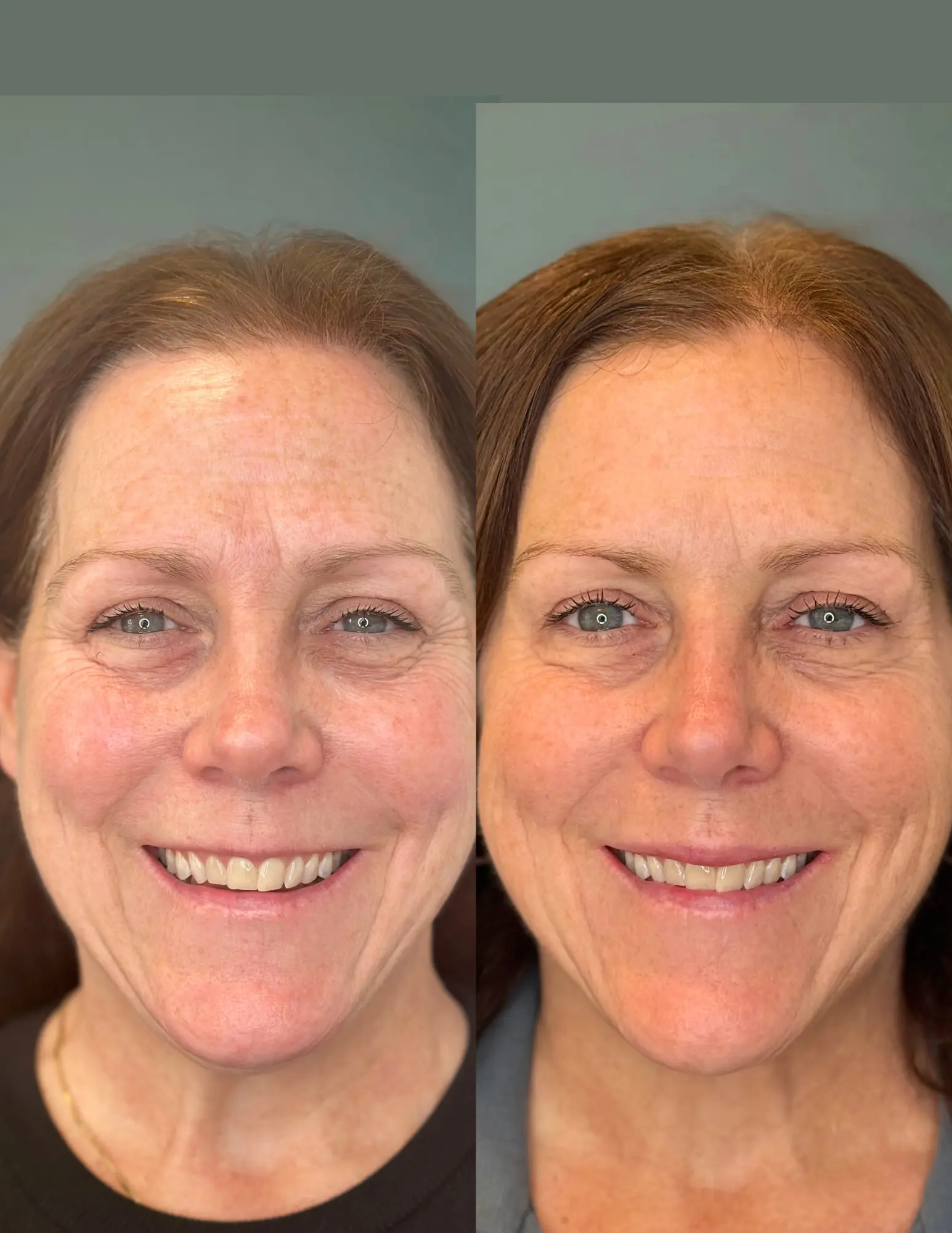Botox before and after - Front view