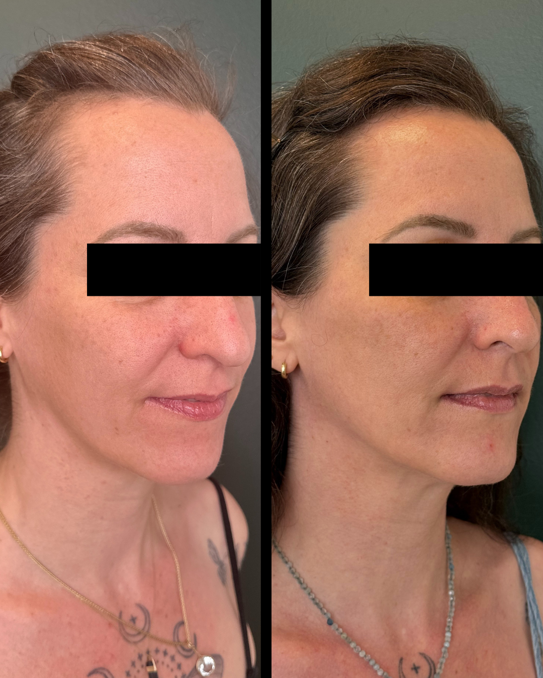 Sculptra before and after - 45 degree angle