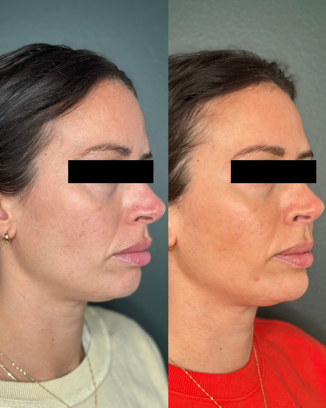 Sculptra before and after - Left side